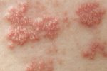 Đông y chữa mụn rộp sinh dục có thật sự hiệu quả?